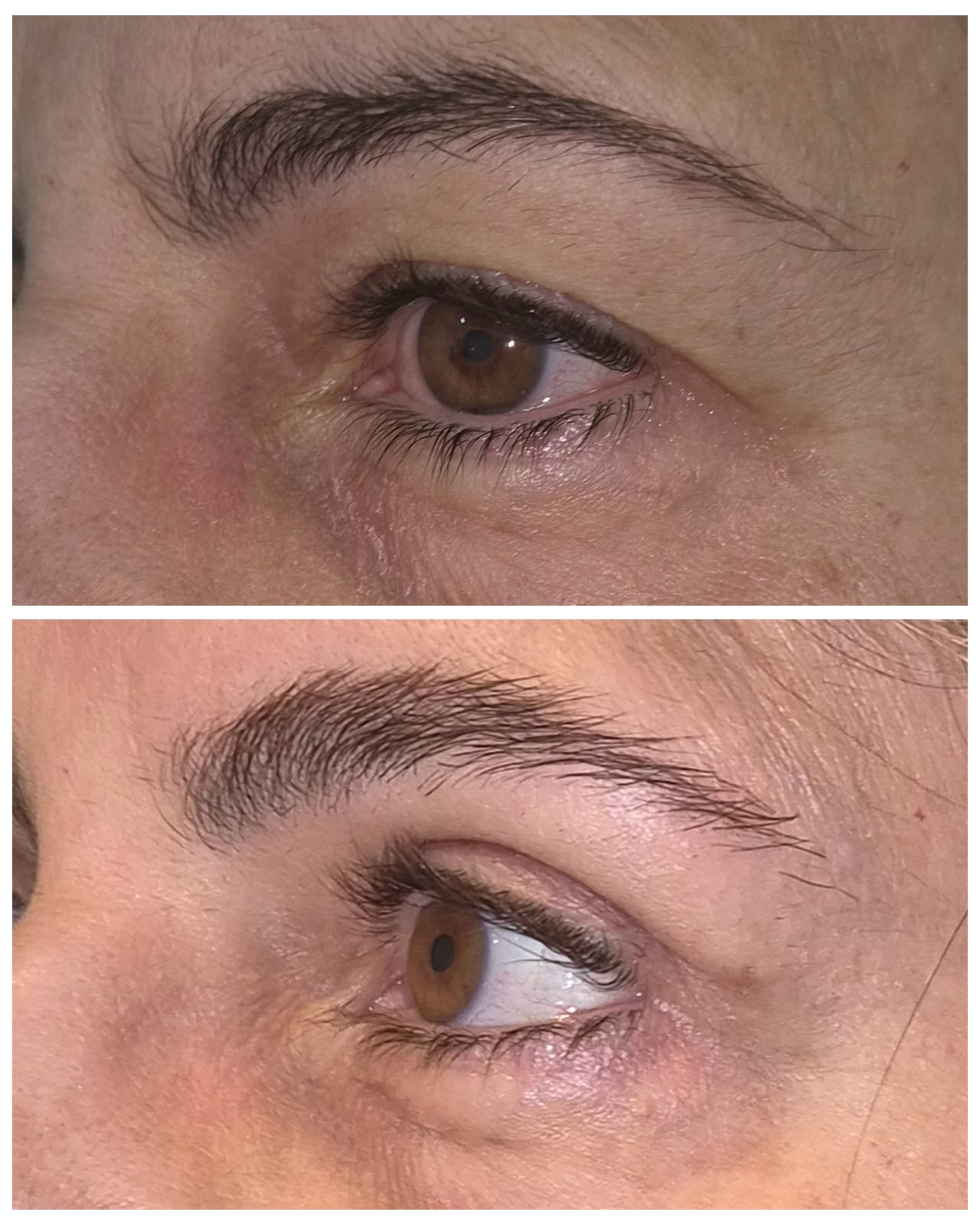 Antes e depois de blefaroplastia 9